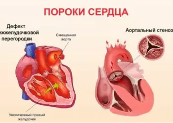 Сохтори нуқсонҳои модарзодии дил